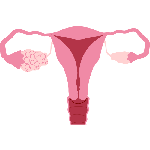 SOPK diététicienne